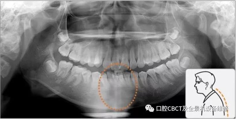 口腔全景片定位线图片