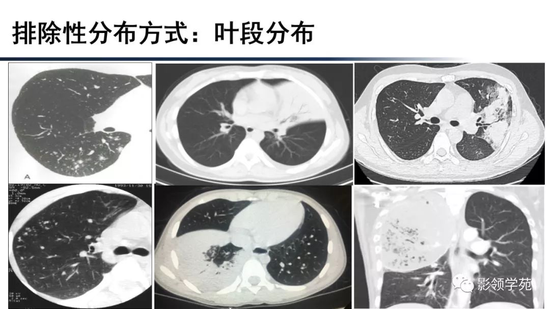 【经典】病毒性肺炎及2019-ncov影像诊断思路_袁怀平