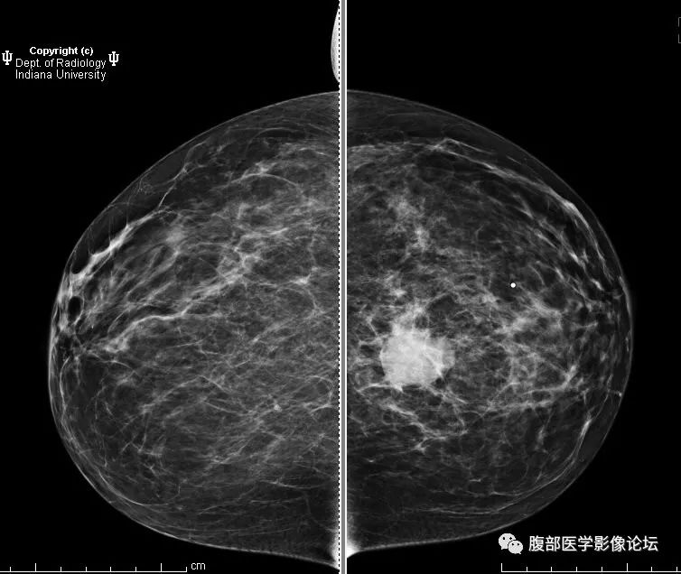 医学影像英语每日读丨95invasiveductalcarcinoma
