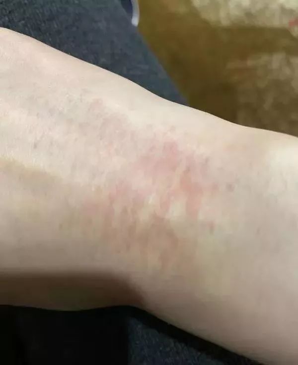 "虽然防护服防护镜不透气,袖口非常紧,一天穿下来,手腕都有深深的勒痕