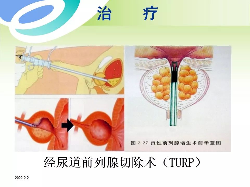 前列腺增生手术示意图图片