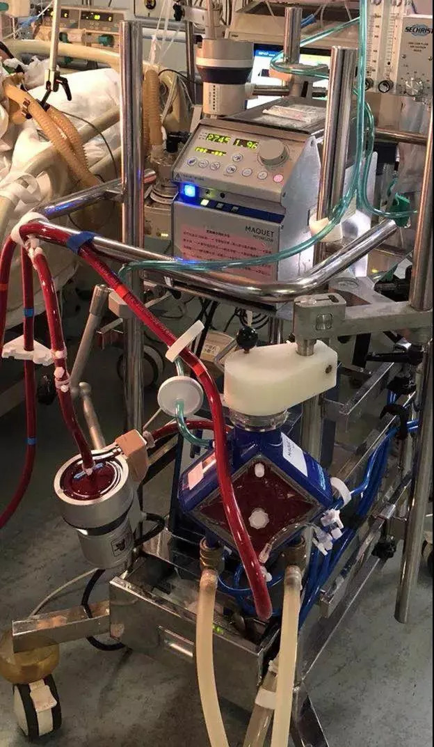 图为抢救肺炎患者的ecmoecmo,俗称"人工肺".
