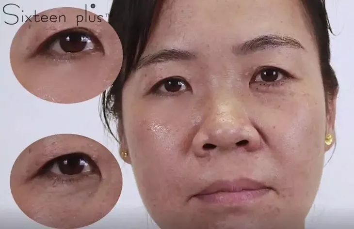 眼袋松弛下垂千万不要动手术用这个两分钟就能消除轻松回到20岁