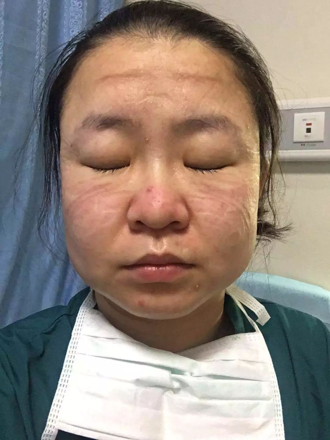 队员贾振秋工作后脸上留下的勒痕被消毒液浸伤的双手队员曹智,刘新磊