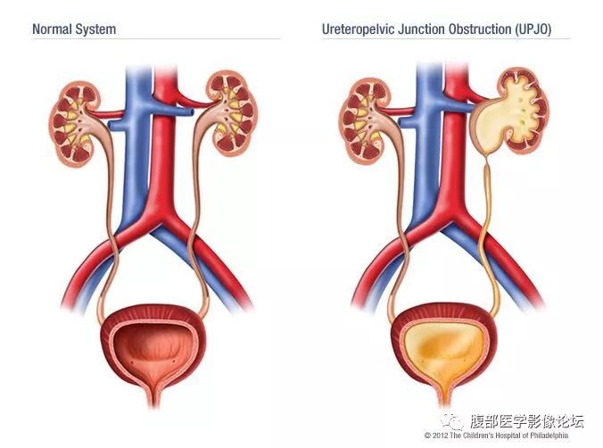 医学影像英语每日读丨97ureteropelvicjunctionobstruction