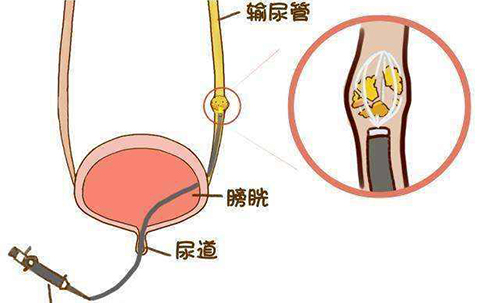 治疗尿道结石推荐技术—输尿管镜取石术,是将纤细的输尿管镜从尿道口