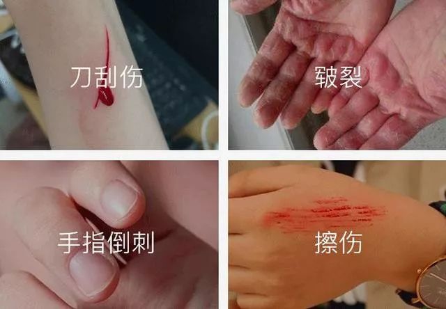 一看到流血,然后就是手忙脚乱的找消毒水和创可贴……因为受伤的地方