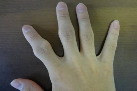 类风湿关节炎骨骼变形还能治好吗