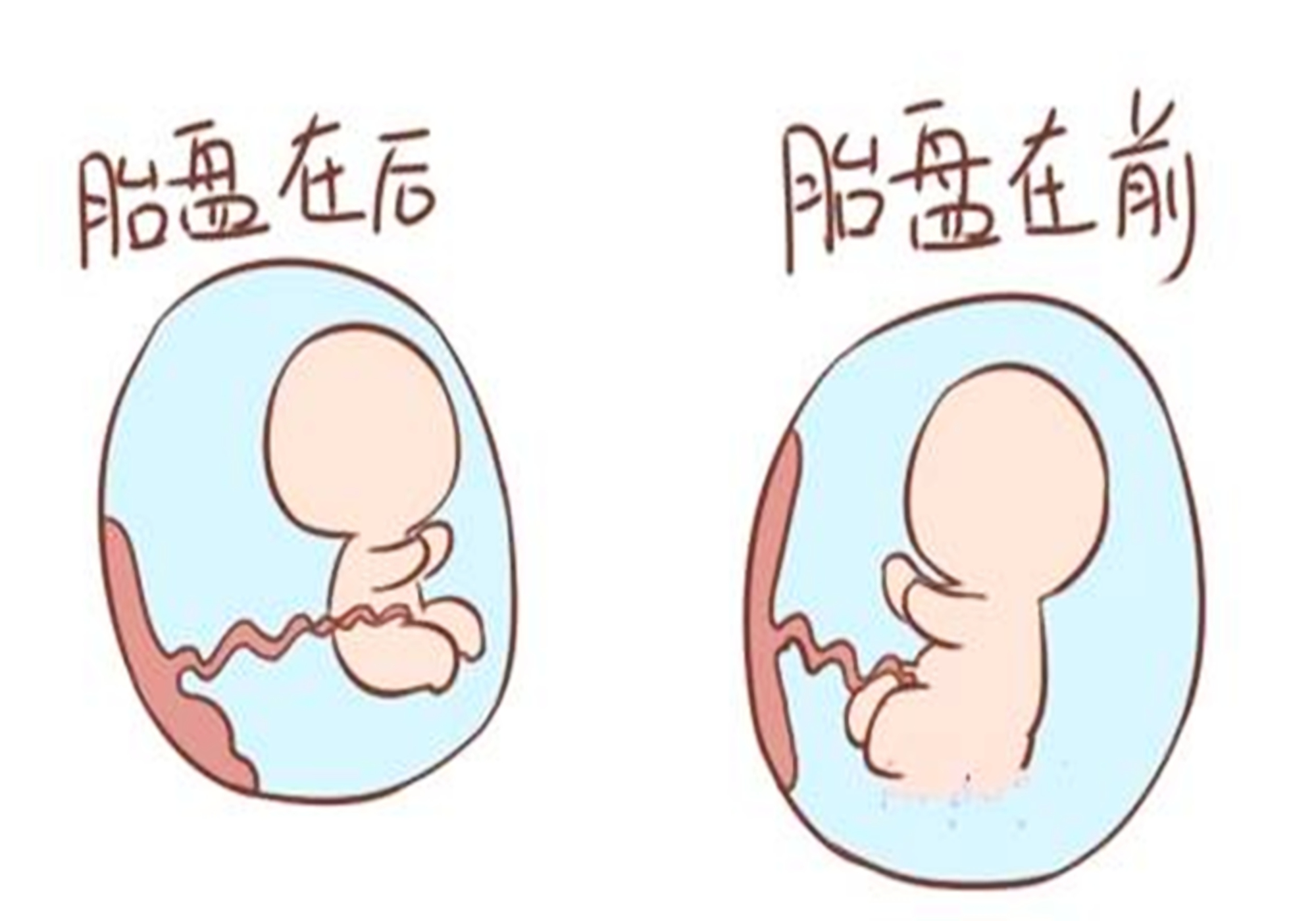 孕妈前壁怀和后壁怀哪个更有优势？区别很明显，优势却谈不上 - 知乎