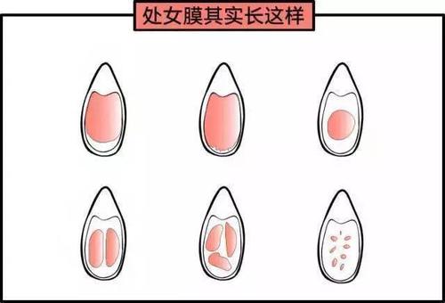 處女膜到底是怎麼回事?