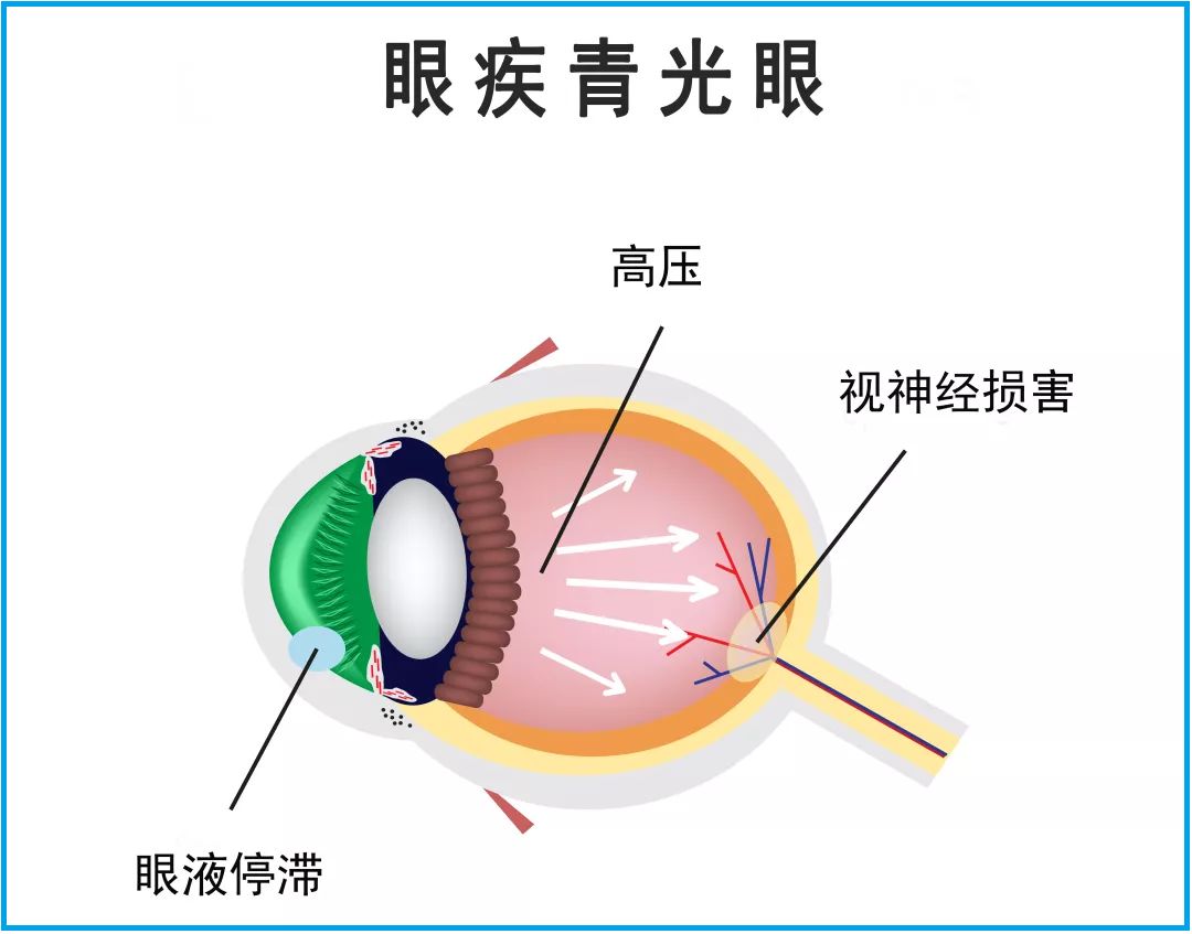 疫情期间,在家千万别熬夜玩手机,易诱发急性青光眼!