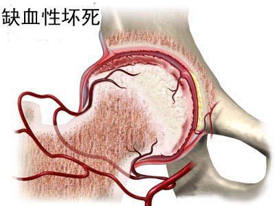 股骨头坏死原因