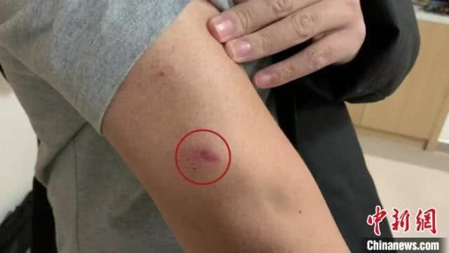 浙大一院医生被新冠肺炎患者咬伤,后续需定期复查_京臣