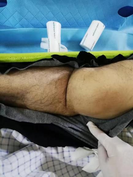 膝关节骨折脱位可能会引起血管损伤,极易造成肢体缺血而导致截肢的