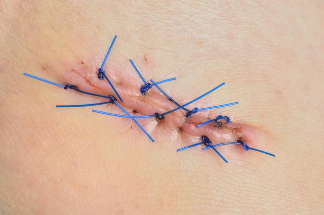 这是因为现在大部分伤口缝合都是采用美容缝合,拆线时只需要将露出