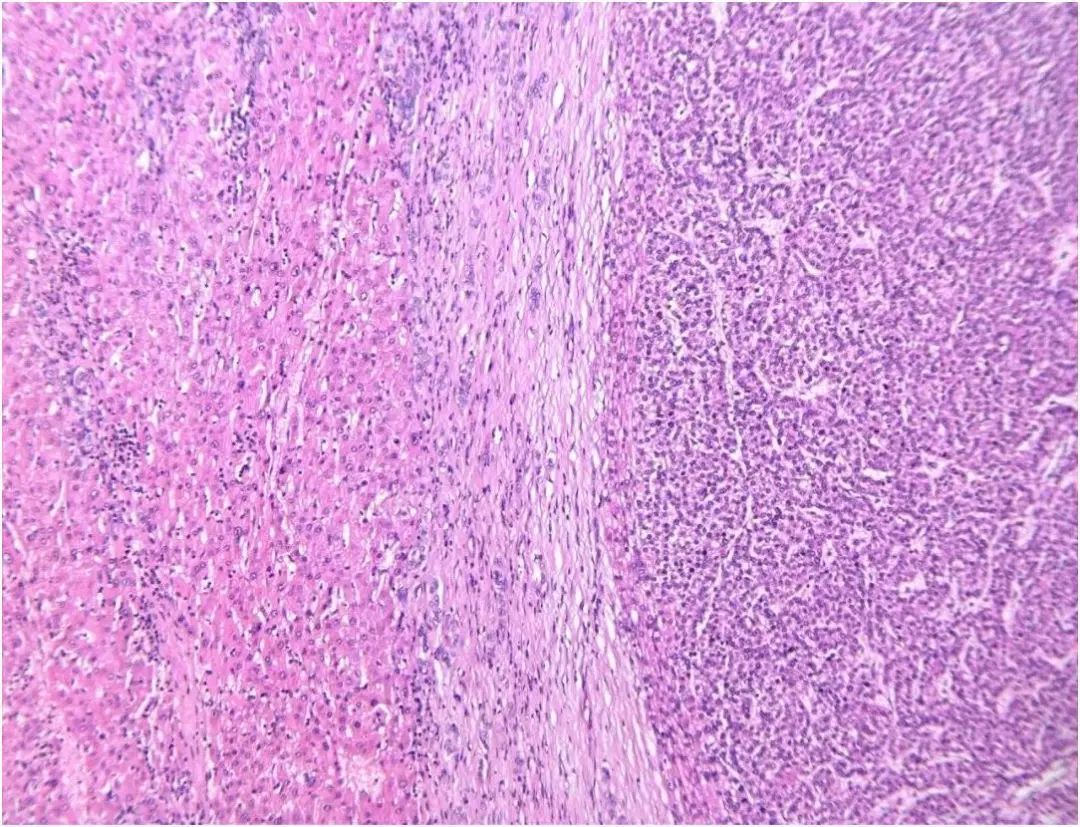 肝细胞癌切片图图片