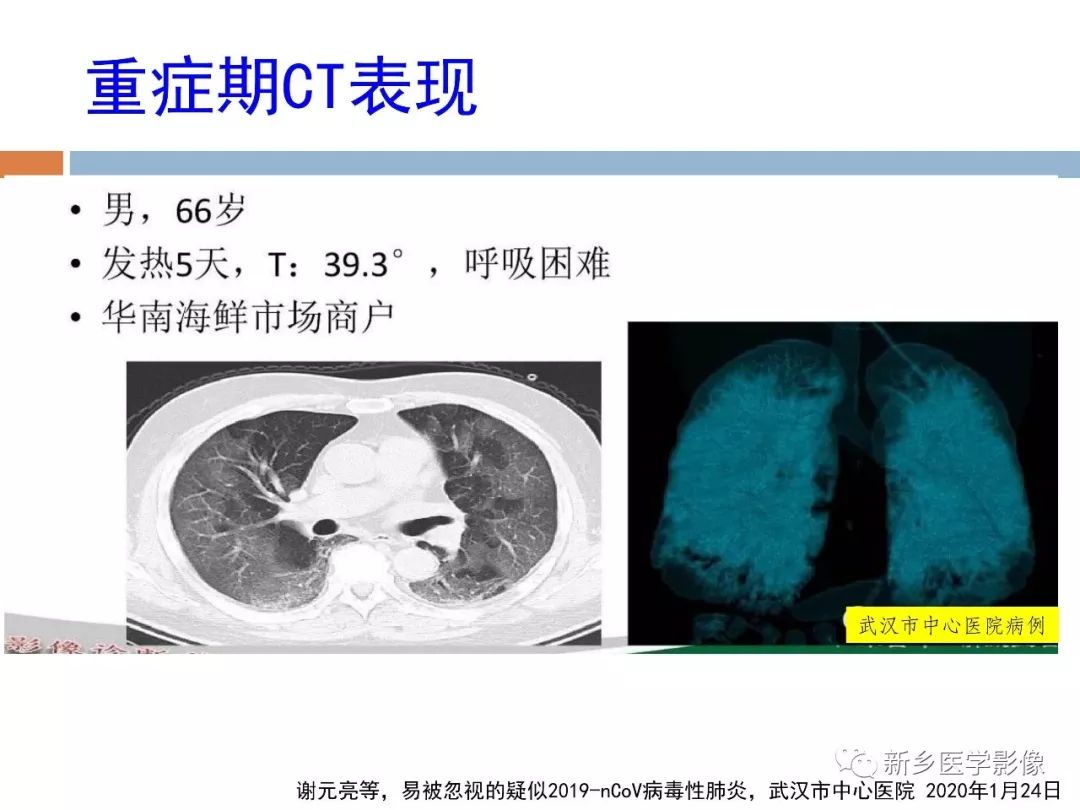 詳細解讀新冠狀病毒肺炎x線ct診斷和鑑別診斷