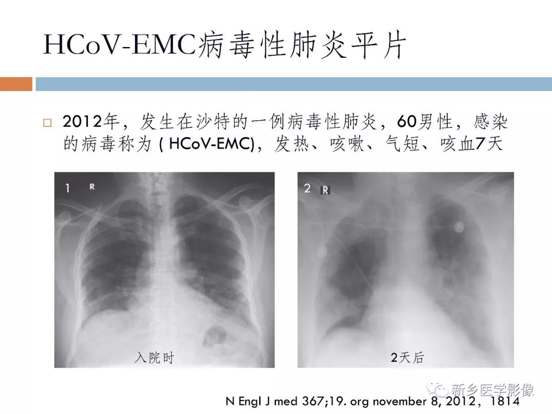 肺炎片子图片及解说图片