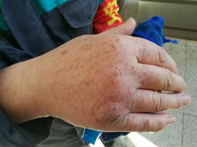 84消毒液过敏的地铁员工"手"01就应该是"天使的印记"吧被护目镜模糊的