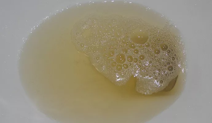 一般,如果发现尿液中存在大量的泡沫,这种尿液又被称为是蛋白尿,一般