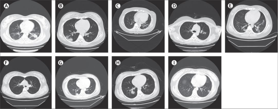 此外在影像學檢查中,8名孕婦的胸部ct提示病毒性肺炎表現,表現為典型