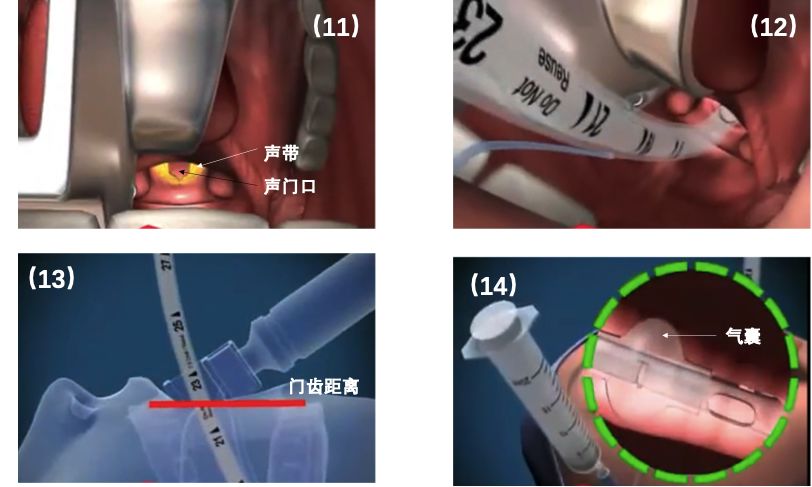 气管插管步骤图 真人图片