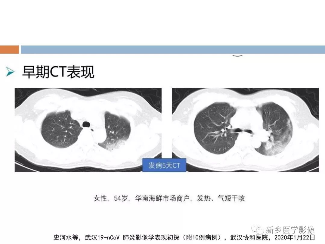 苯扎氯铵新冠状肺炎图片