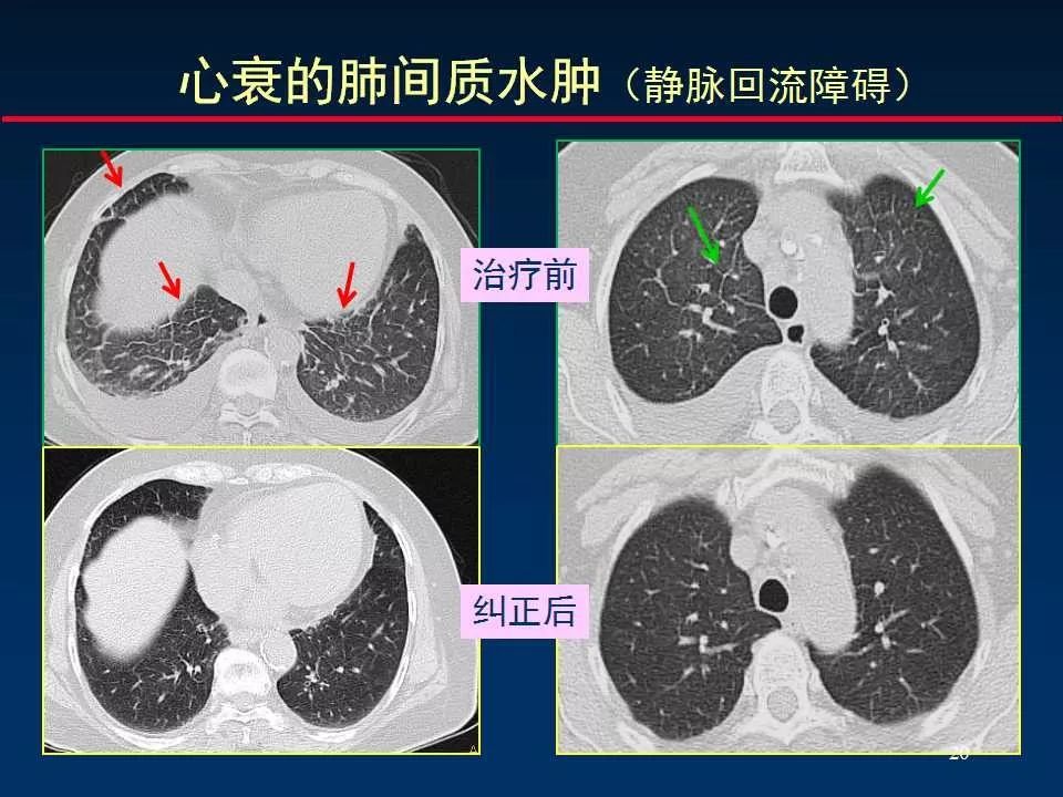 師說丨正確判讀肺間質改變的基本ct表現_解剖