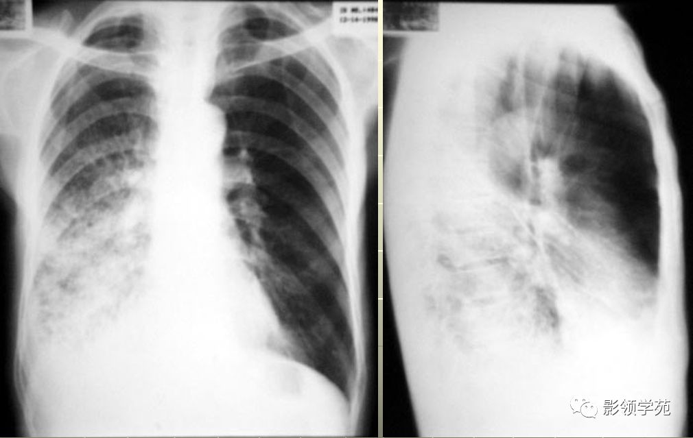 原发性肺结核x线表现图片