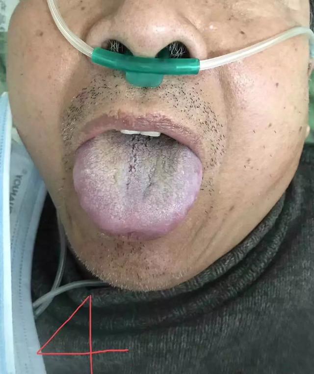 这个舌象青紫,瘀堵严重,舌苔灰黑而焦燥,为热极津枯.