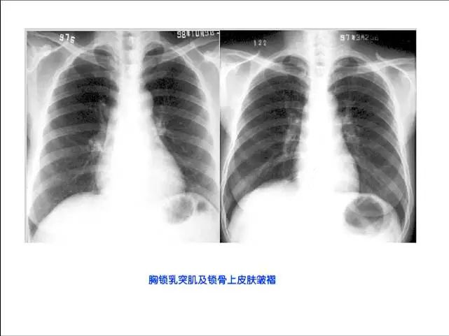 输尿管结石照片名称:输尿管结石3照片名称:食管裂孔疝x线表现照片名称