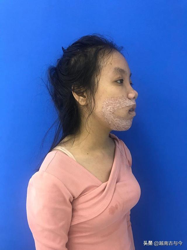 越南龅牙女孩因颜值自卑为改变决心整容最终逆袭成大美女