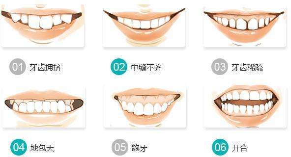 汕頭哪個醫院牙齒矯正比較好牙齒矯正不當產生的危害