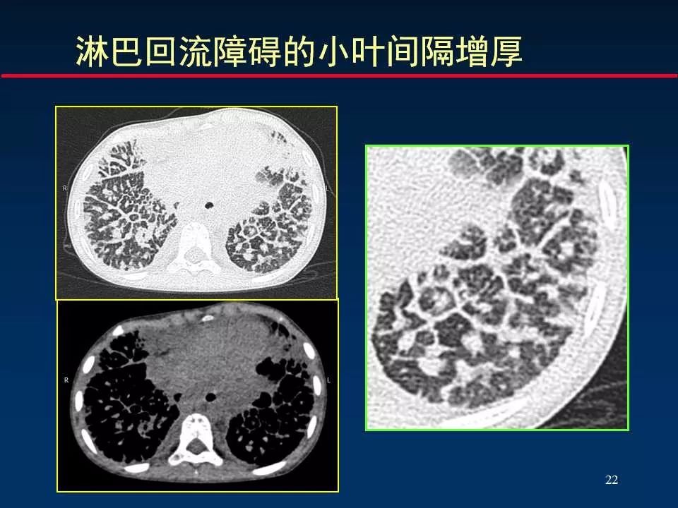 师说丨正确判读肺间质改变的基本ct表现