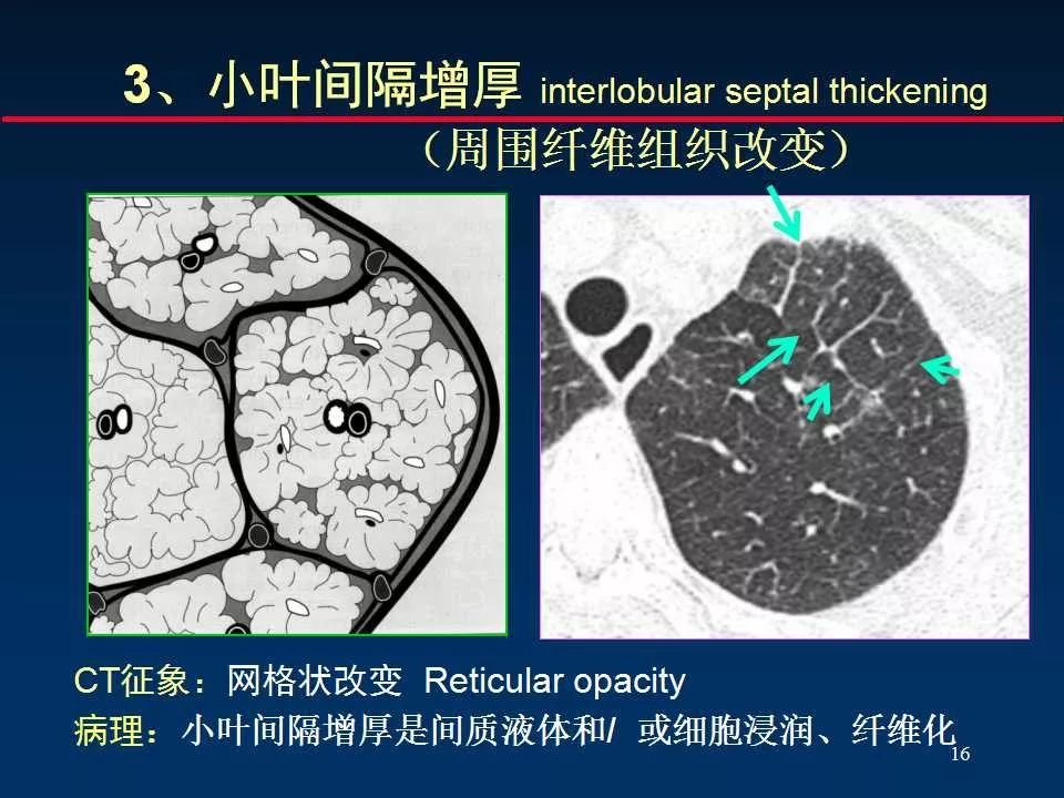 肺间质肺实质图解图片