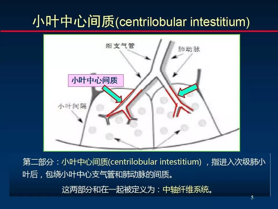 间隔中轴纤维系统:支气管血管周围间质和小叶中心间质◆ 肺间质分为三