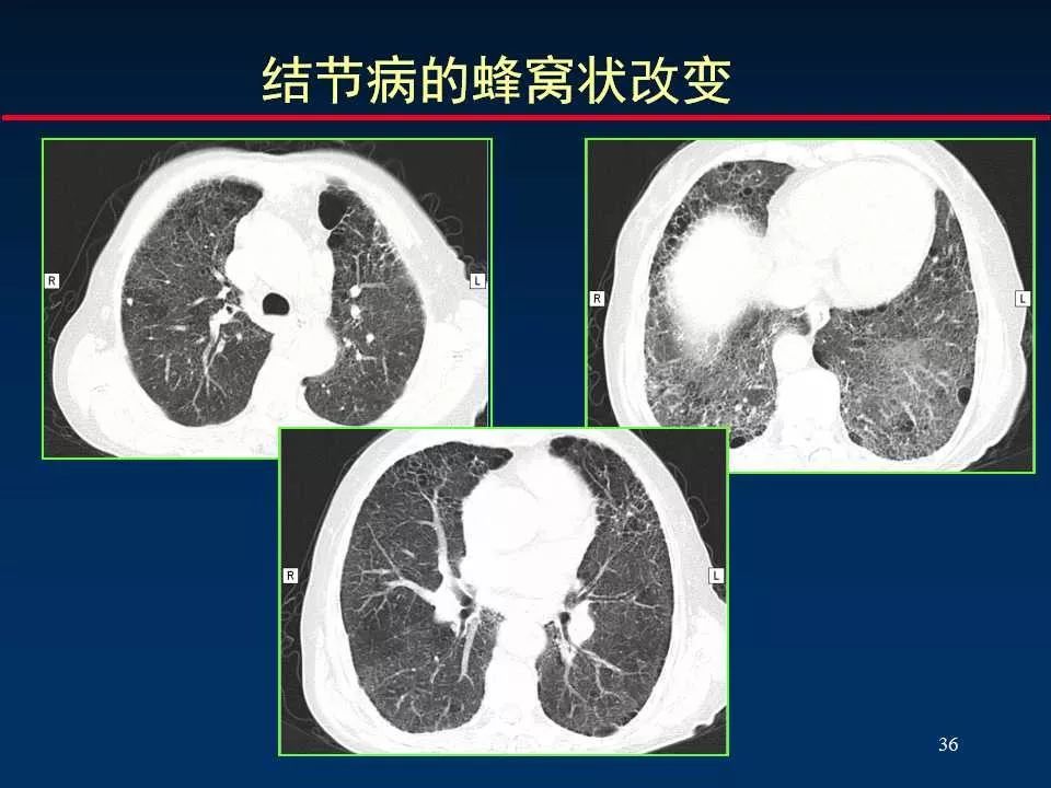 师说丨正确判读肺间质改变的基本ct表现