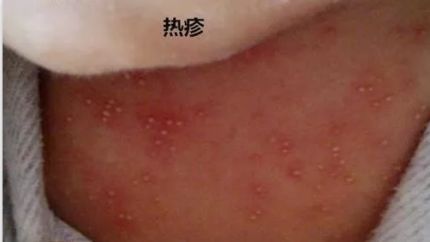 是当婴儿身体周围的温度过高时,皮肤上出现淡红色皮疹的一种症状,这种