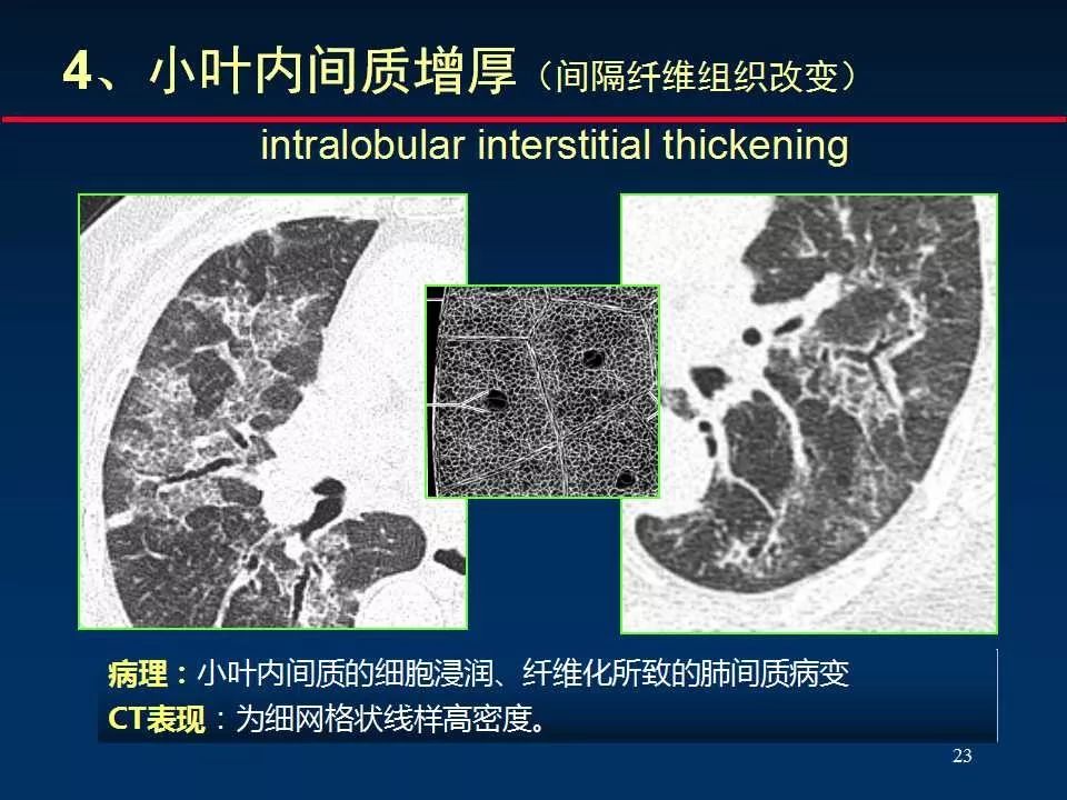 师说丨正确判读肺间质改变的基本ct表现