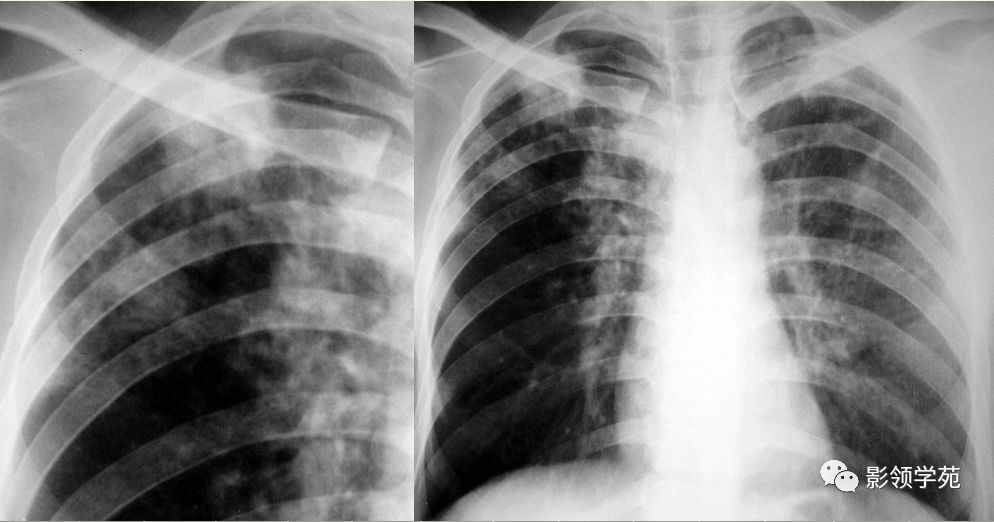 结核球附近肺野可见散在的结核病灶,如增殖,纤维化,钙化等● 影像