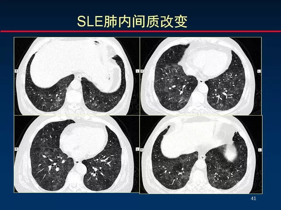 师说丨正确判读肺间质改变的基本ct表现