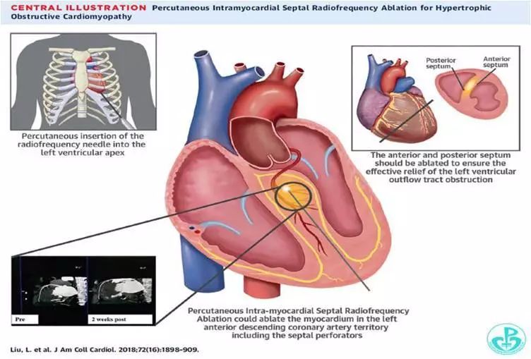 打开心脏的堰塞湖肥厚性梗阻型心肌病导管消融精准治疗