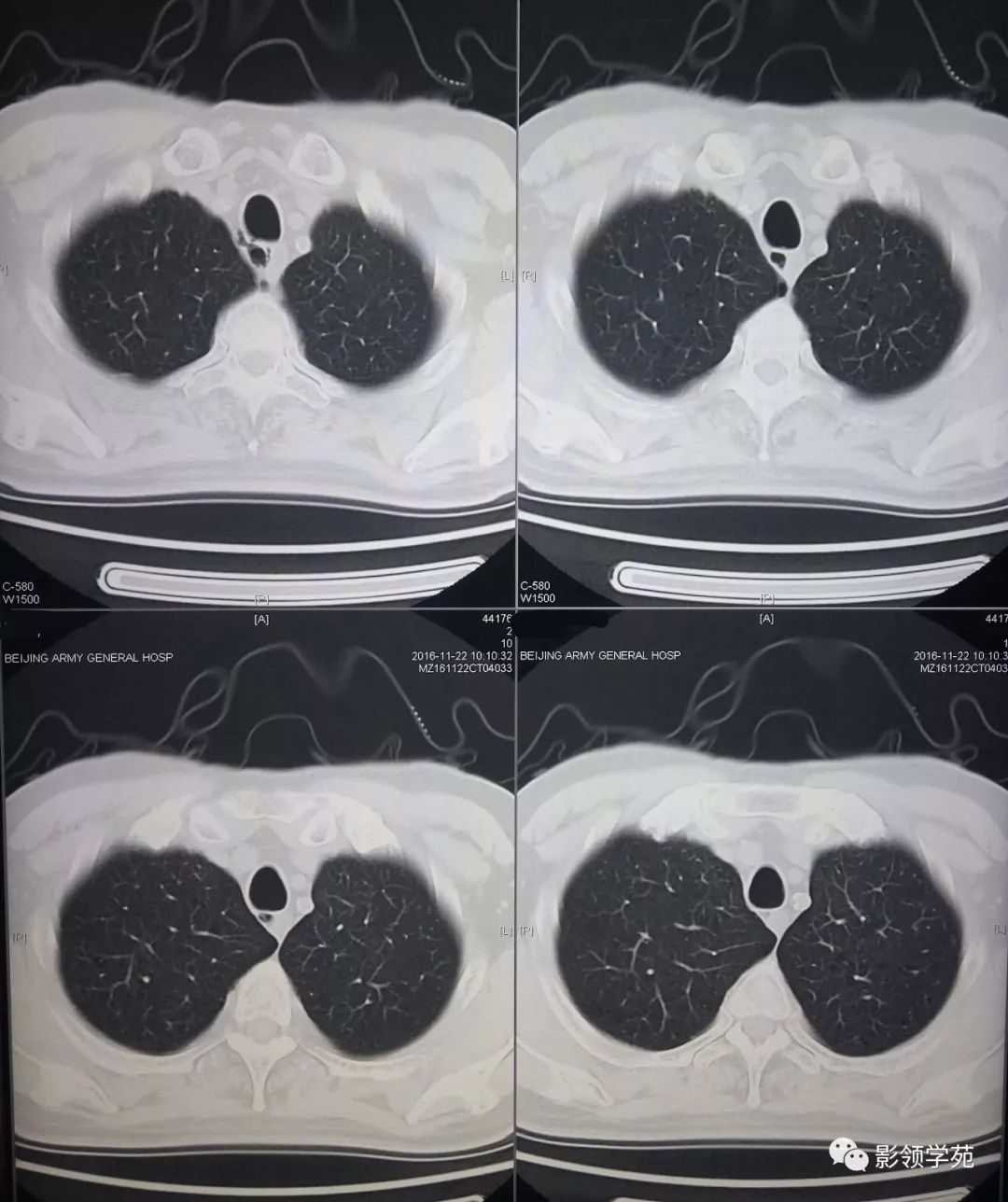 胸痛查体67气管憩室