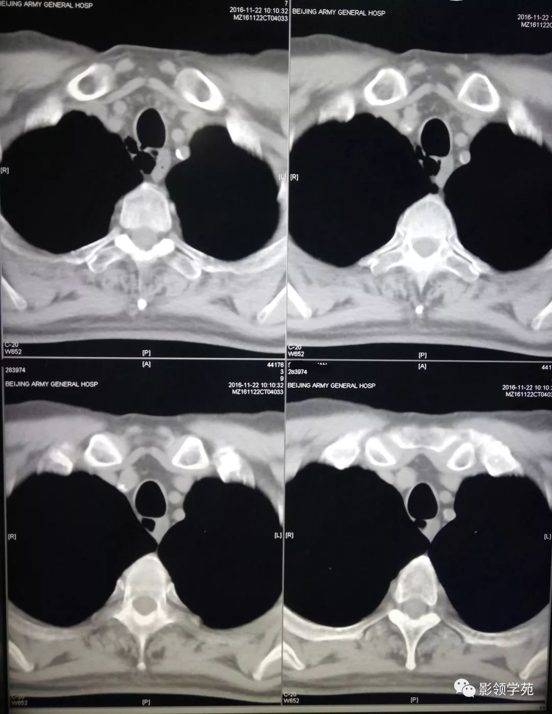 胸痛查体67气管憩室