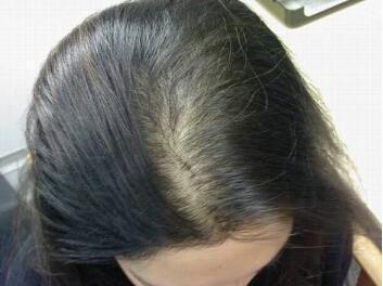 女性得了脂溢性脱发,还有治好的可能吗?