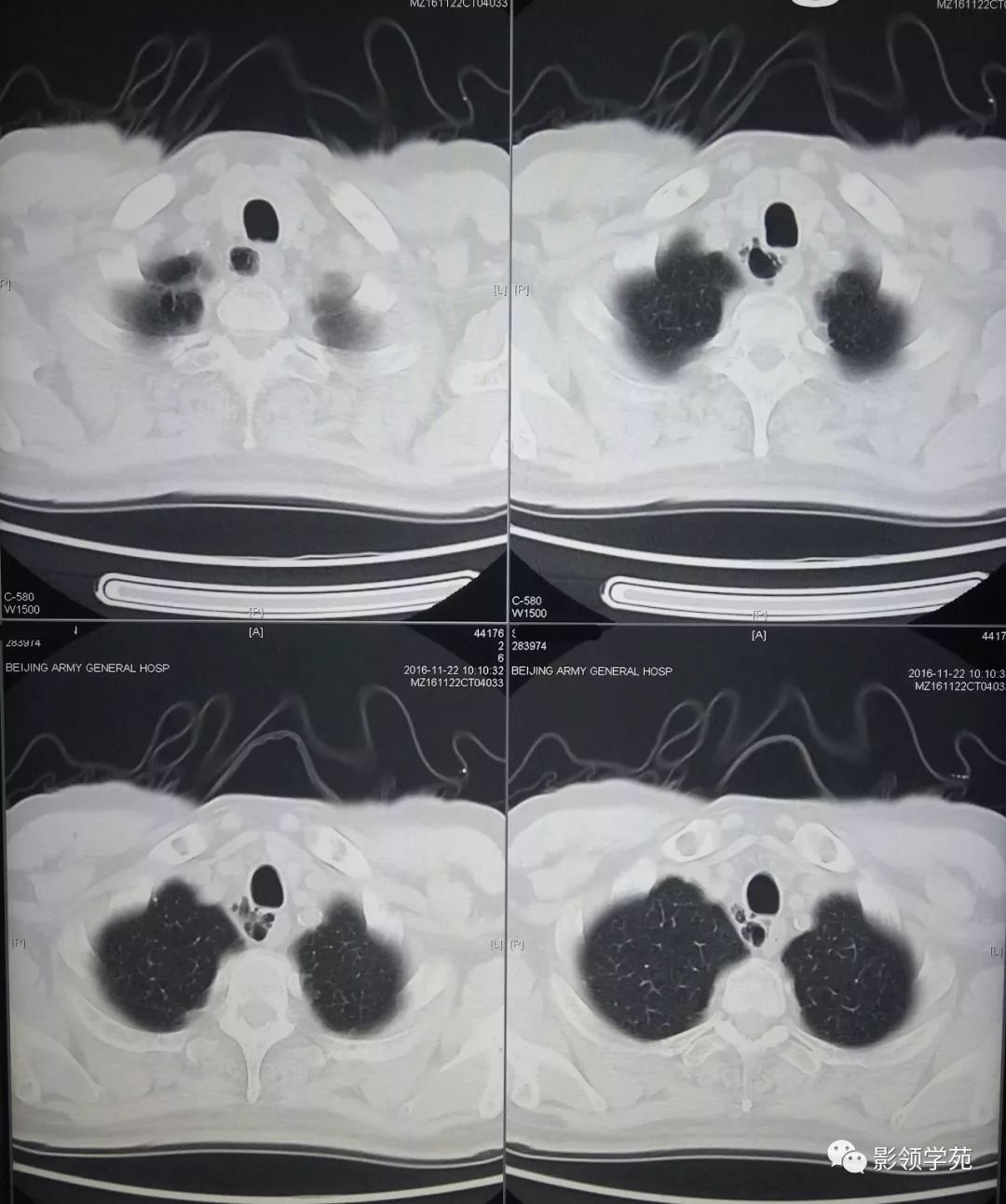 胸痛查体67气管憩室