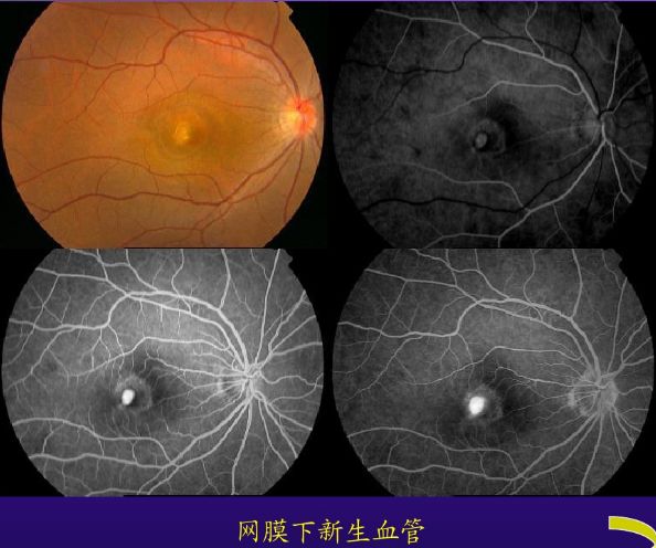 荧光素眼底血管造影术的基础知识