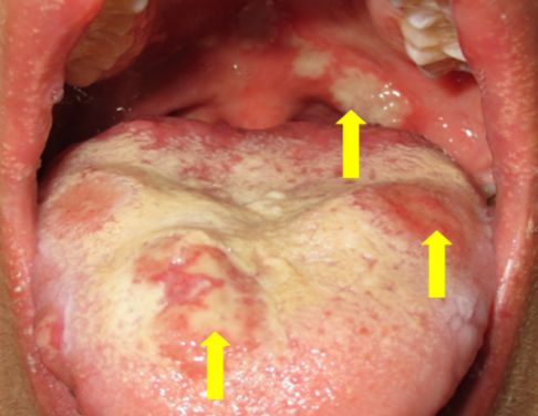 马婧媛医师提供嘴巴里出现一个或数个圆形或椭圆形的黄白色溃疡,灼痛