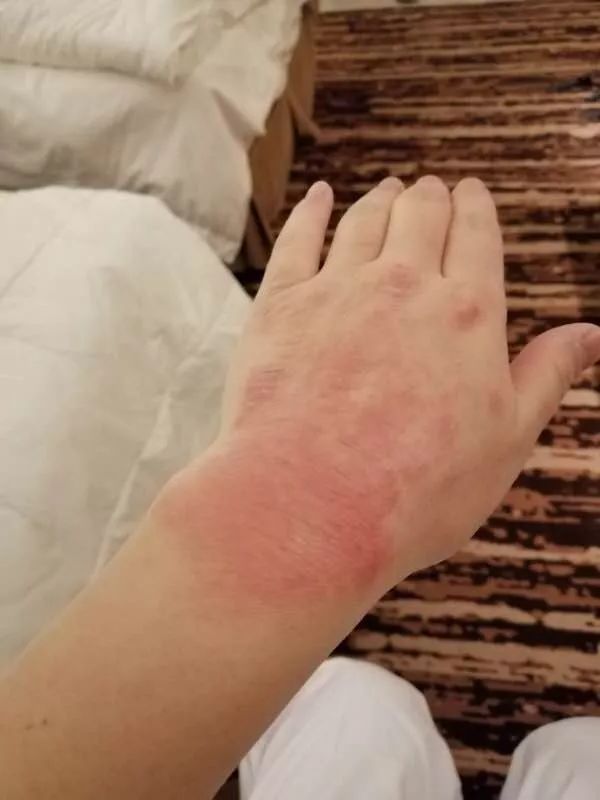 抗疫医护人员受伤的手图片