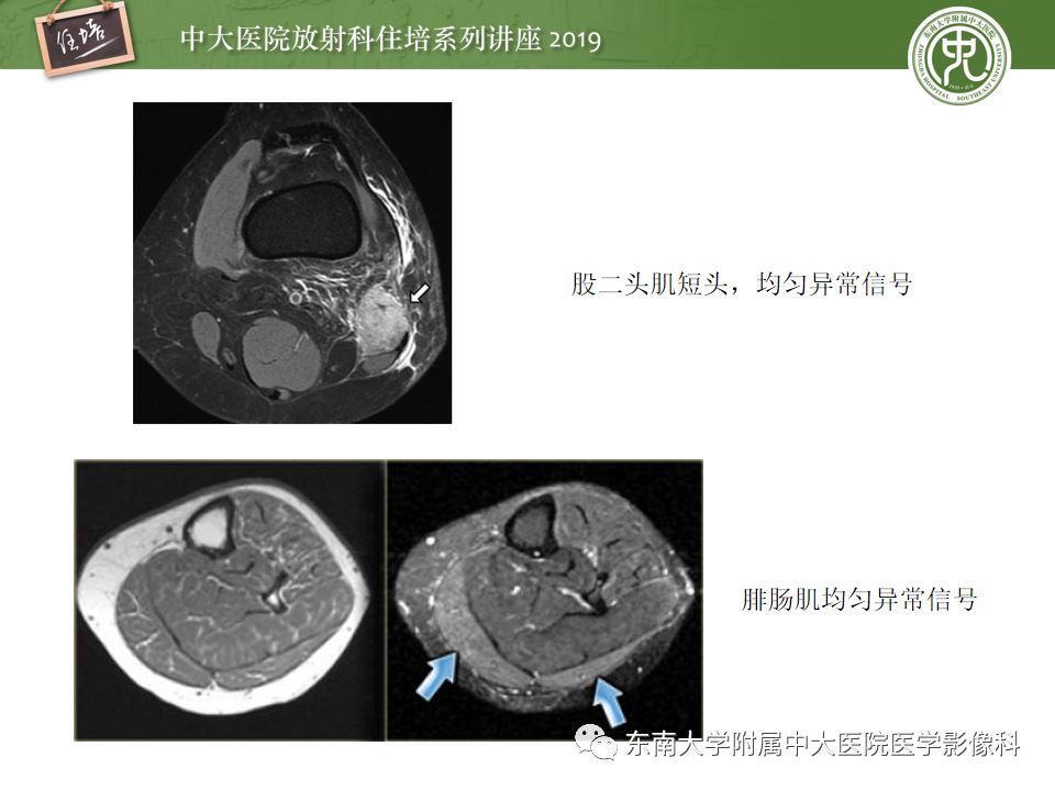 大腿肌肉核磁解剖图片